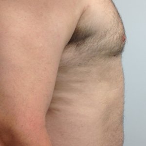 manhattan gynecomastia surgery after 4